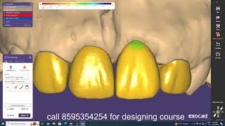 Exocad Video TutorialHow to Design in EXOCAD Anterior Teethin hindi [upl. by Spillar]