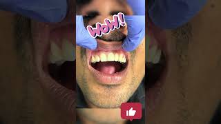 Best ceramic cap braces anatomy rootcanal mbbs dentalcare science dentalinte dentalclinic [upl. by Joel]