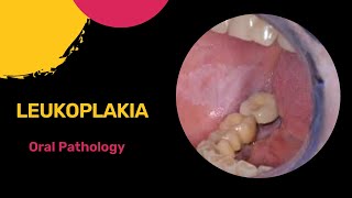 Leukoplakia  White Patch  Oral Pathology  Neet MDS  Dental Care [upl. by Alarice]