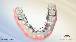 Orthodontic Expander or Spacer  Lower BiHelix Appliance [upl. by Aridni113]