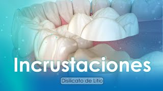 Proceso de Fabricación de Incrustaciones Dentales con Tecnología CADCAM  Servidident [upl. by Archer913]