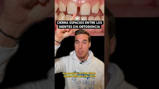 Cerrar DIASTEMAS o ESPACIOS entre los DIENTES sin ortodoncia [upl. by Aratahs]