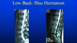 Low Back Anatomy with pinched nerves disc ruptures amp pain [upl. by Amahs233]