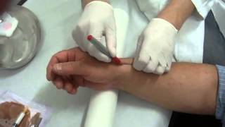 UltrasoundGuided Corticosteroid Injection for the Treatment of de Quervains Tenosynovitis [upl. by Eirual579]