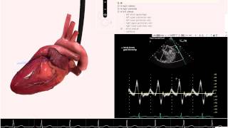 HeartWorks Multilobed Left Atrial Appendage [upl. by Adalai320]