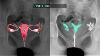 Fallopian Tube Recanalization and Selective Salpingography [upl. by Spector]