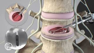 OptiLIF® Endo System  Spineology  4K Animation [upl. by Enaywd]