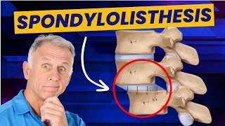 Spondylolisthesis Treatment Routine For Best Recovery All Ages [upl. by Haliak21]