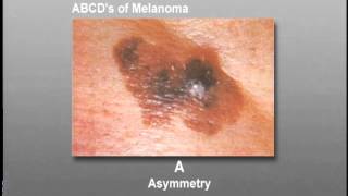 How To Identify Skin Cancer [upl. by Eirased]