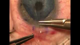 DMEK Cornea Transplant Surgery  Riverwoods Eye Center Provo UT [upl. by Pontius276]