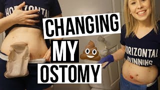 CHIT CHAT amp CHANGING MY OSTOMY BAG [upl. by Nirac]