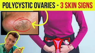 Doctor explains 3 SKIN SIGNS ASSOCIATED WITH POLYCYSTIC OVARIAN SYNDROME PCOS [upl. by Oran]