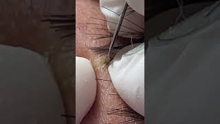 Wow  Acne Treatment Mai Ngoc pimple acnetreatments acne blackheads acneskintreatment maingoc [upl. by Short]