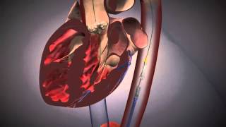 Cardiologie  TAVI Procedure EdwardsXT [upl. by Small]