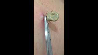 Tick removal by US doctor [upl. by Hardan689]