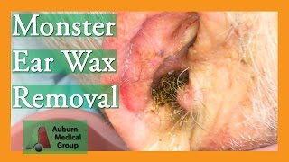 Monster Ear Wax Removal Brings New Life to JOKESTER Patient  Auburn Medical Group [upl. by Runkel]