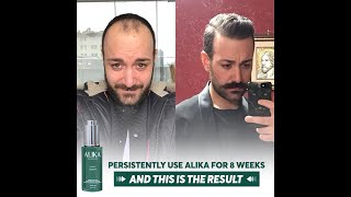 Our FDAapproved Alika Hair Restoration System [upl. by Aienahs]