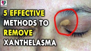 5 Effective Methods to Remove Xanthelasma  Best Health Tips for CHRONIC DISEASES [upl. by Baldridge]