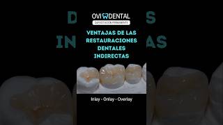 📢 Ventajas de las restauraciones dentales indirectas Onlay Inlay overlay restauracióndental [upl. by Lorelle]