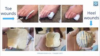 Applying Enluxtra SelfAdaptive wound dressing on small foot ulcers [upl. by Vevine]