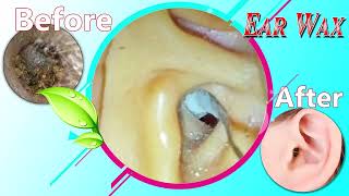 Ear Wax Removal Myths Debunked What You Need to Know 056 [upl. by Combs26]