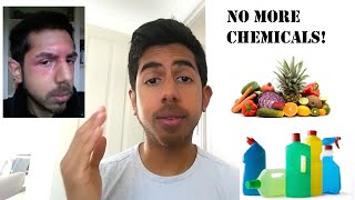 Dyshidrotic Eczema  Atopic Dermatitis  Natural Healing Tips [upl. by Hazlett]