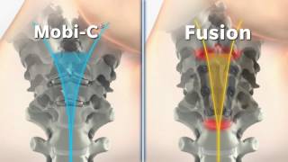 Mobi C vs Cervical Fusion Animation [upl. by Sanford]