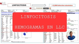 LINFOCITOSIS HEMOGRAMAS DE LEUCEMIA LINFOCÍTICA CRÓNICA [upl. by Vladamar]