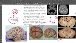 5 Lissencephaly [upl. by Middle981]