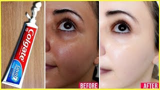 Apply Toothpaste on Your Skin and See Magical Result within 1 Hour ¦Amazing Toothpaste Beauty Hacks [upl. by Wimsatt508]