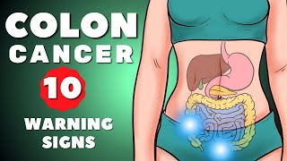 10 Warning Signs of Colon Cancer You Shouldn’t Ignore  HEALTH VIDEO [upl. by Dorthy]