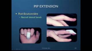 Obstinate PIP Joint Part 10 of 12 Active Redirection for PIP Joint Extension Discussion [upl. by Yoho]