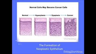 Metaplasia heteroplasia dysplasia neoplasia hyperplasia and anaplasia [upl. by Aikemahs]