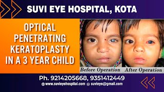 Optical Penetrating Keratoplasty in a 3 Year Child SuVi Eye Institute amp Lasik Laser Center Kota In [upl. by Anirat]