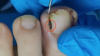 【Daily Pedicure Tutorial】Removing Deeply Embedded Ingrown Toenails on Both Sides of The Big Toe [upl. by Alam]