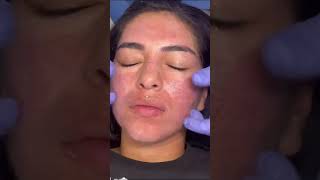 Rosas Acne Scar Journey Continues with Sublative Laser [upl. by Aicnatsnoc]