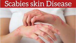 Scabies Signs Symptoms Causes and Treatment [upl. by Bergin684]