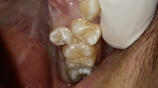 Exodontia malposed Upper Premolar [upl. by Nosahc]