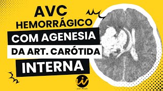 AVC Hemorrágico com Agenesia da Artéria Carótida Interna [upl. by Aerdma]