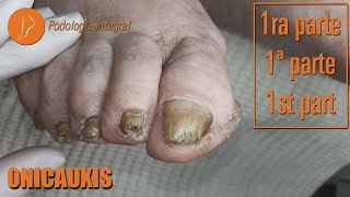 Onicauxis onychomycosis amp callosities Part 1 podologiaintegral [upl. by Suolhcin]