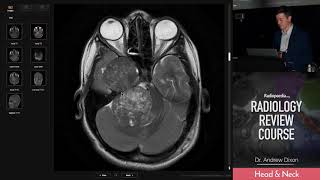 Trigeminal Schwannoma  Radiology Review Course [upl. by O'Dell806]