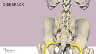 Diskbråck Spine Center Göteborg [upl. by Norris589]