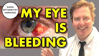 HOW TO TREAT BROKEN BLOOD VESSEL IN EYE what does it mean amp how to treat bleeding or bloodshot eye [upl. by Blader]