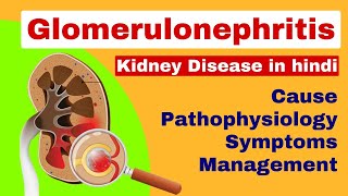 Glomerulonephritis  Nephritis in hindi  kidney disease  medical surgical nursing lecture [upl. by Nahsab]