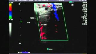 perforator veins of the right leg1b [upl. by Lutim]