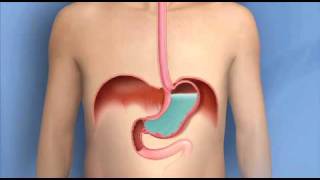 Heartburn Acid Reflux GERDMayo Clinic [upl. by Tallu]