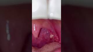 Tonsil Cyst Removal [upl. by Negroj]