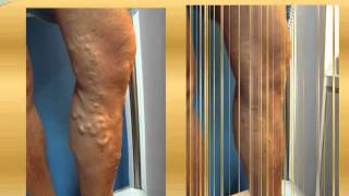 Varicose vein before and after Part 3  varicose vein treatment varicose surgery [upl. by Les460]