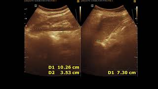 Ultrasound cases 332 of 2000  Cystitis UB diverticuli histerectomy [upl. by Otsirave]