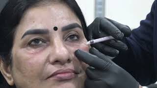 Full Facelift With Fillers  Facial Aesthetics Training  Dr Akshay Bagade  facialist [upl. by Accire]